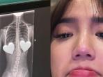Cara Mencegah Skoliosis, Kelainan Tulang yang Diderita Selebgram Fuji