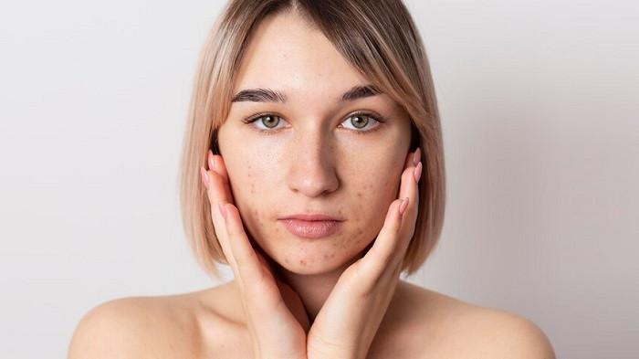 Ilustrasi kulit berjerawat akibat sering gonta-ganti skincare | foto freepik