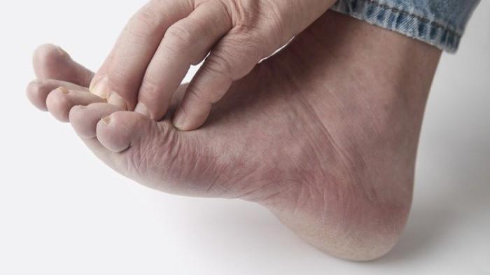 Infeksi jamur kaki. (alodokter)