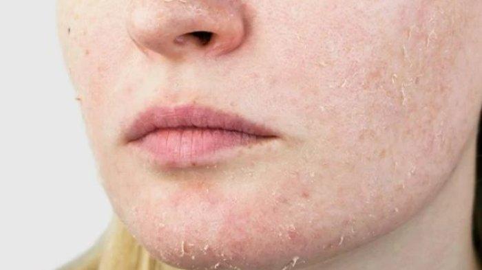 Ilustrasi kulit wajah iritasi (tribunews.com)