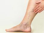 5 Cara Mudah Hilangkan Varises di Tubuh dengan Bahan Alami, Bisa Dilakukan di Rumah