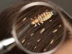 5 Cara Membasmi Kutu di Rambut hanya Pakai Bahan Alami, Selamat Tinggal Gatal!
