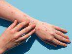 6 Wilayah yang Kena Sebaran Kasus Mpox di Indonesia per Agustus 2024, Ketahui Gejala dan Upaya Pencegahannya